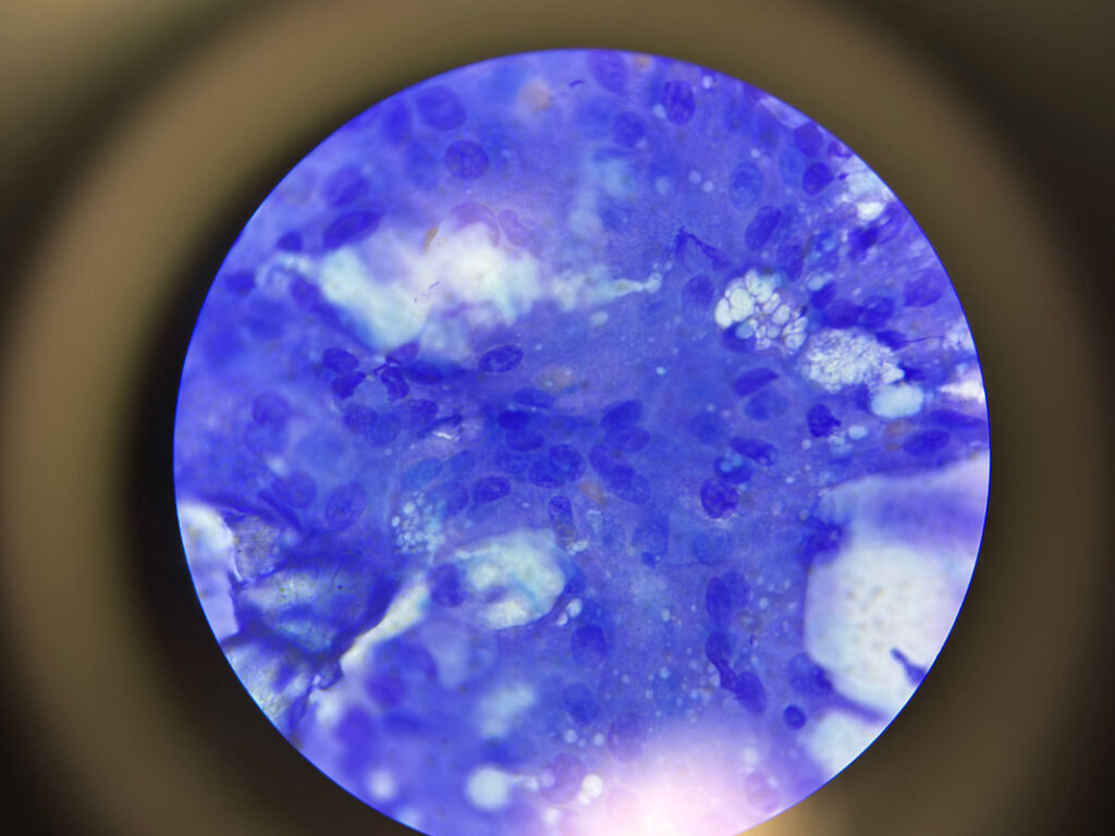 Examen citologic FNA la microscop – celule adenom perianal câine mascul necastrat senior, colorație albastră